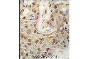 Formalin-fixed and paraffin-embedded human lung carcinoma tissue reacted with cGKII antibody (C-term) (ABIN392537 and ABIN2842089) , which was peroxidase-conjugated to the secondary antibody, followed by DAB staining. (PRKG2 Antikörper  (C-Term))