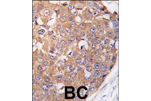 Formalin-fixed and paraffin-embedded human breast carcinoma tissue reacted with PLK2 polyclonal antibody  , which was peroxidase-conjugated to the secondary antibody, followed by DAB staining. (PLK2 Antikörper  (C-Term))
