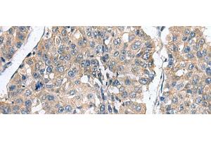 Immunohistochemistry of paraffin-embedded Human liver cancer tissue using CLEC1B Polyclonal Antibody at dilution of 1:60(x200) (C-Type Lectin Domain Family 1, Member B (CLEC1B) Antikörper)