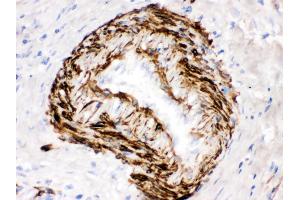 SMYD3 was detected in paraffin-embedded sections of human intestinal cancer tissues using rabbit anti- SMYD3 Antigen Affinity purified polyclonal antibody at 1 μg/mL. (SMYD3 Antikörper  (C-Term))