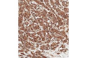 Immunohistochemical analysis of paraffin-embedded human breast carcinoma tissue using (ABIN6242215 and ABIN6577457) performed on the Leica® BOND RXm. (Cathepsin D Antikörper  (AA 1-412))
