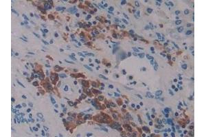 Detection of LAT2 in Human Lung cancer Tissue using Polyclonal Antibody to Linker For Activation Of T-Cells Family, Member 2 (LAT2) (LAT2 Antikörper  (AA 30-209))