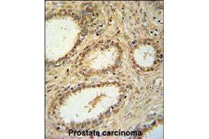 SNRNP40 Antibody immunohistochemistry analysis in formalin fixed and paraffin embedded human prostate carcinoma followed by peroxidase conjugation of the secondary antibody and DAB staining. (SNRNP40 Antikörper  (AA 122-149))