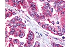 Anti-CDC7 antibody IHC of human Ovary, Carcinoma. (CDC7 Antikörper  (Kinase Domain))