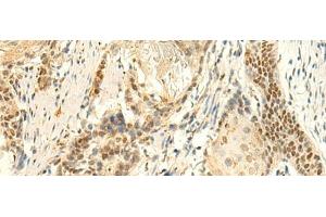 Immunohistochemistry of paraffin-embedded Human esophagus cancer tissue using HMBOX1 Polyclonal Antibody at dilution of 1:50(x200)