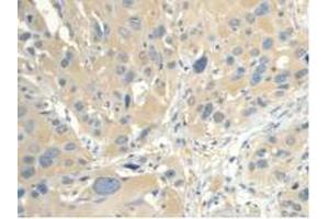 IHC-P analysis of Human Esophagus Cancer Tissue, with DAB staining. (CALML3 Antikörper  (AA 1-149))