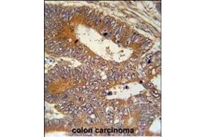 P1S Antibody (Center) (ABIN651956 and ABIN2840474) immunohistochemistry analysis in forlin fixed and paraffin embedded hun colon carcino followed by peroxidase conjugation of the secondary antibody and DAB staining. (MAP1S Antikörper  (AA 493-520))