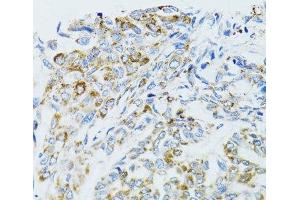 Immunohistochemistry of paraffin-embedded Human liver cancer using EGFR Polyclonal Antibody at dilution of 1:100 (40x lens). (EGFR Antikörper)