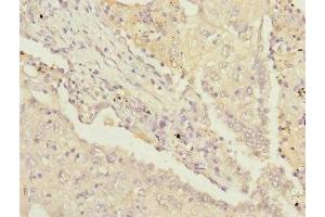 Immunohistochemistry of paraffin-embedded human lung cancer using ABIN7142207 at dilution of 1:100 (PSMD13 Antikörper  (Regulatory Subunit 13))