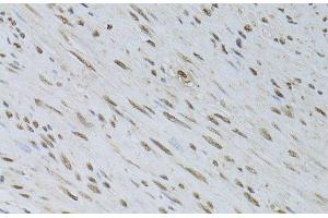 Immunohistochemistry of paraffin-embedded Human uterine cancer using HDGFRP3 Polyclonal Antibody at dilution of 1:100 (40x lens). (HDGFRP3 Antikörper)