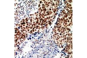Immunohistochemical analysis of TEAD2 staining in human breast cancer formalin fixed paraffin embedded tissue section.