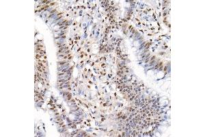 Immunohistochemistry of paraffin-embedded human colon carcinoma using Phospho-Smad2-S465/467 + Smad3-S423/425 Rabbit pAb (ABIN6135314, ABIN6136248, ABIN6136249 and ABIN6225575) at dilution of 1:50 (40x lens). (SMAD2 / SMAD3 (pSer423), (pSer425) Antikörper)