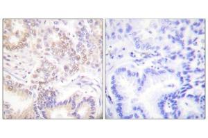Immunohistochemistry analysis of paraffin-embedded human lung carcinoma tissue using SENP5 antibody. (SENP5 Antikörper  (C-Term))