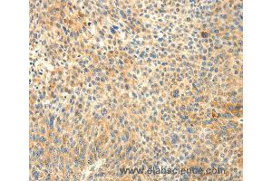 Immunohistochemistry of Human liver cancer using TRAF3IP2 Polyclonal Antibody at dilution of 1:30
