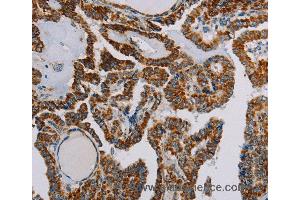 Immunohistochemistry of Human thyroid cancer using NDUFS3 Polyclonal Antibody at dilution of 1:30