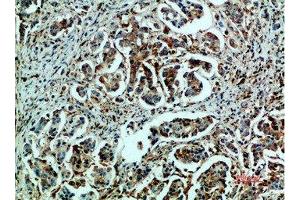 Immunohistochemical analysis of paraffin-embedded human-breast-cancer, antibody was diluted at 1:200