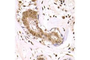 Immunohistochemistry of paraffin-embedded human breast cancer using ODC1 antibody at dilution of 1:200 (400x lens). (ODC1 Antikörper)