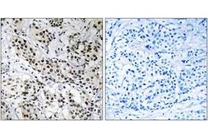 Immunohistochemistry analysis of paraffin-embedded human breast carcinoma tissue, using APBB2 Antibody. (APBB2 Antikörper  (AA 471-520))