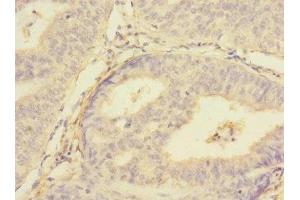 Immunohistochemistry of paraffin-embedded human endometrial cancer using ABIN7159959 at dilution of 1:100 (PMPCA Antikörper  (AA 456-525))