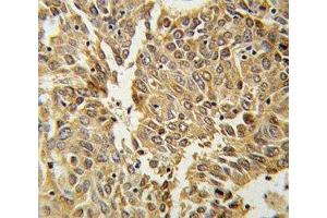 HIF1 alpha antibody IHC analysis in formalin fixed and paraffin embedded lung carcinoma. (HIF1A Antikörper  (AA 1-30))