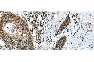 Immunohistochemistry of paraffin-embedded Human esophagus cancer tissue using GLI1 Polyclonal Antibody at dilution of 1:40(x200) (GLI1 Antikörper)