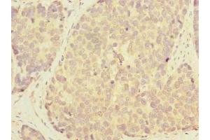 Immunohistochemistry of paraffin-embedded human gastric cancer using ABIN7163860 at dilution of 1:100