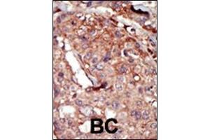 Formalin-fixed and paraffin-embedded human cancer tissue reacted with the primary antibody, which was peroxidase-conjugated to the secondary antibody, followed by AEC staining. (BRD2 Antikörper  (AA 170-200))