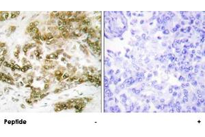 Immunohistochemistry analysis of paraffin-embedded human breast carcinoma tissue using TBX15/TBX18 polyclonal antibody . (T-Box 15 Antikörper)