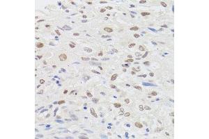 Immunohistochemistry of paraffin-embedded human lung cancer using HMGN1 antibody. (HMGN1 Antikörper  (AA 1-100))