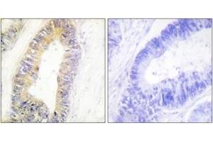 Immunohistochemistry analysis of paraffin-embedded human colon carcinoma tissue, using ZNF638 Antibody. (ZNF638 Antikörper  (AA 1271-1320))