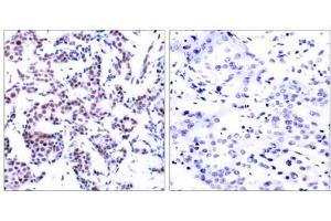 Immunohistochemical analysis of paraffin-embedded human breast carcinoma using JunB (phospho-Ser259) antibody (E011027). (JunB Antikörper  (pSer259))