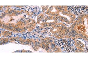 Immunohistochemistry of paraffin-embedded Human thyroid cancer using NCEH1 Polyclonal Antibody at dilution of 1:80 (NCEH1 Antikörper)