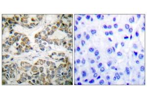 Immunohistochemical analysis of paraffin-embedded human breast carcinoma tissue using Shc (phospho-Tyr349) antibody. (SHC1 Antikörper  (pTyr349))