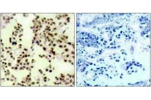 Immunohistochemistry analysis of paraffin-embedded human lung carcinoma, using p73 (Phospho-Tyr99) Antibody. (Tumor Protein p73 Antikörper  (pTyr99))
