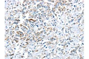 The image on the left is immunohistochemistry of paraffin-embedded Human gastric cancer tissue using ABIN7193036(VWCE Antibody) at dilution 1/30, on the right is treated with synthetic peptide. (VWCE Antikörper)