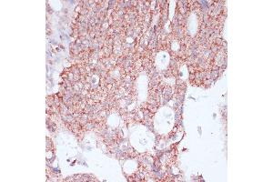 Immunohistochemistry of paraffin-embedded human colon carcinoma using RPL30 antibody (ABIN6130903, ABIN6147135, ABIN6147136 and ABIN6217777) at dilution of 1:100 (40x lens). (RPL30 Antikörper  (AA 1-115))