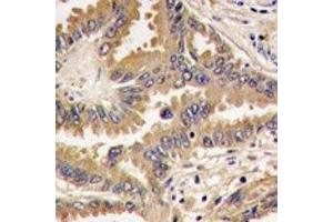 IHC analysis of FFPE human lung carcinoma tissue stained with Bad antibody (BAD Antikörper  (AA 53-81))