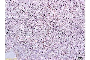 Formalin-fixed and paraffin embedded human nasopharyngeal carcinoma labeled with Anti-NKG2D/CD314/KLRK1 Polyclonal Antibody, Unconjugated (ABIN730078) at 1:200, followed by conjugation to the secondary antibody and DAB staining (KLRK1 Antikörper  (AA 121-219))