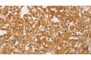 Immunohistochemistry of paraffin-embedded Human thyroid cancer tissue using CEBP beta Polyclonal Antibody at dilution 1:60 (CEBPB Antikörper)