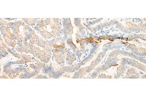 Immunohistochemistry of paraffin-embedded Human thyroid cancer tissue using CELA3A Polyclonal Antibody at dilution of 1:25(x200) (Elastase 3A Antikörper)