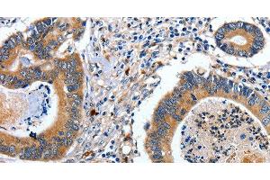 Immunohistochemistry of paraffin-embedded Human colon cancer tissue using EFNB2 Polyclonal Antibody at dilution 1:80 (Ephrin B2 Antikörper)
