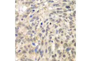 Immunohistochemistry of paraffin-embedded human esophageal cancer using TLK2 antibody at dilution of 1:100 (x40 lens). (TLK2 Antikörper)