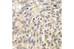 Immunohistochemistry of paraffin-embedded human esophageal cancer using TLK2 antibody at dilution of 1:100 (x40 lens).