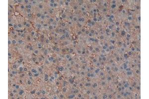 IHC-P analysis of Human Liver cancer Tissue, with DAB staining. (Hemoglobin Subunit beta Antikörper  (AA 1-147))