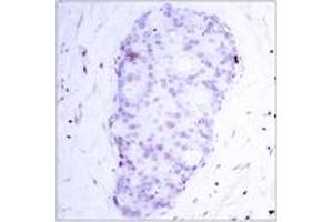 Immunohistochemistry analysis of paraffin-embedded human breast carcinoma, using NF-kappaB p105/p50 (Phospho-Ser907) Antibody. (NFKB1 Antikörper  (pSer907))
