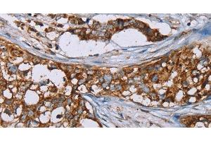 Immunohistochemistry of paraffin-embedded Human breast cancer using BMP6 Polyclonal Antibody at dilution of 1:50 (BMP6 Antikörper)