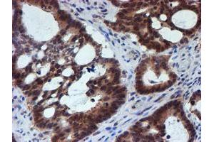 Immunohistochemical staining of paraffin-embedded Adenocarcinoma of Human colon tissue using anti-RUVBL2 mouse monoclonal antibody. (RUVBL2 Antikörper  (AA 113-370))