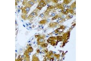Immunohistochemical analysis of BLVRB staining in human liver cancer formalin fixed paraffin embedded tissue section.