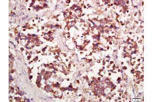 Formalin-fixed and paraffin embedded human lung carcinoma labeled with Anti-PPP4C Polyclonal Antibody, Unconjugated (ABIN669261) at 1:200 followed by conjugation to the secondary antibody and DAB staining (PPP4C Antikörper  (AA 265-307))