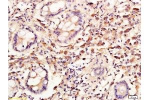 Formalin-fixed and paraffin embedded: human colon carcinoma labeled with Anti-Cyclin C Polyclonal Antibody, Unconjugated  at 1:300, followed by conjugation to the secondary antibody and DAB staining (Cyclin C Antikörper  (AA 23-100))